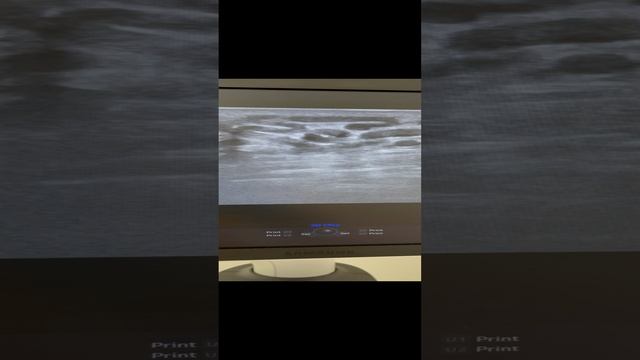 Часть 1. Варикоцеле 4 ст. Узи паховой области. Сосудистый хирург. Флеболог Москва смотреть онлайн