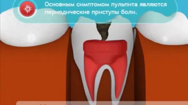 Пульпит - Что такое пульпит, как он образуется смотреть онлайн
