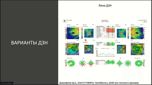 ОКТ при глаукоме. Атипичные ДЗН смотреть онлайн