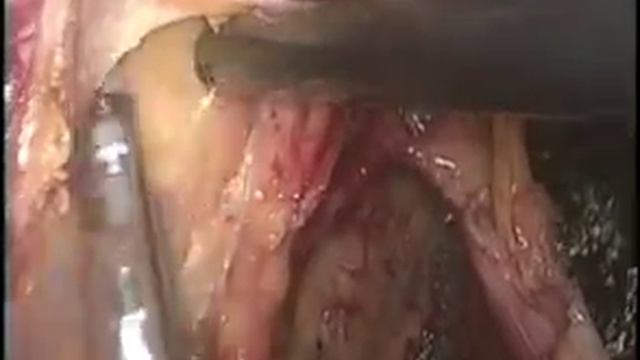 Laparoscopic lateral pelvic lymph node dissection смотреть онлайн