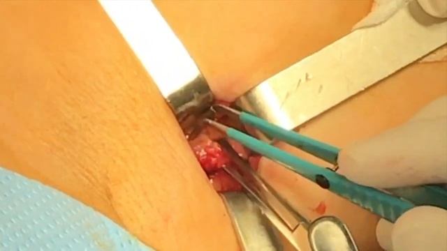 Breast Cancer : SENTINEL LYMPH NODE смотреть онлайн