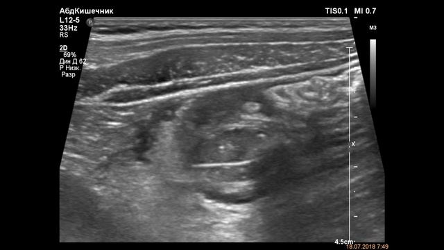 Ретроцекальный аппендицит у ребёнка/retrocecal Appendicitis In A Child