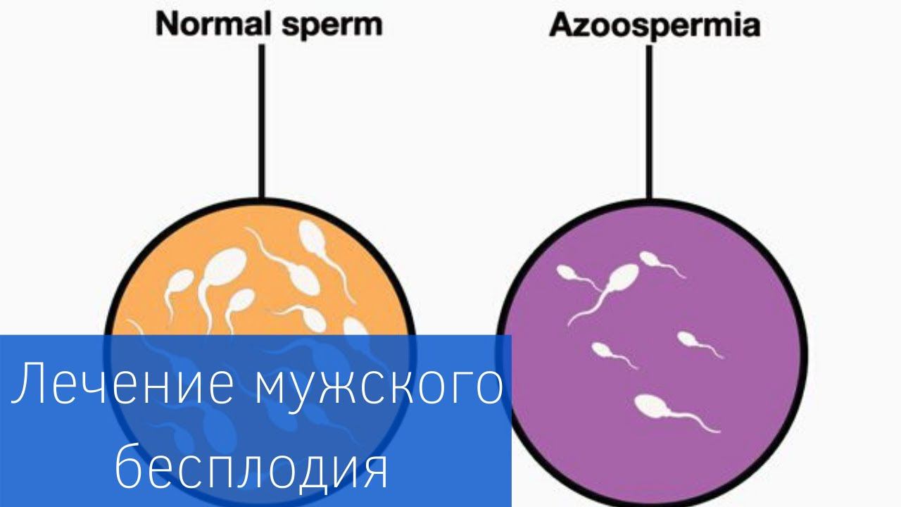 МУЖСКОЕ БЕСПЛОДИЕ | Азооспермия: диагностика и лечение смотреть онлайн