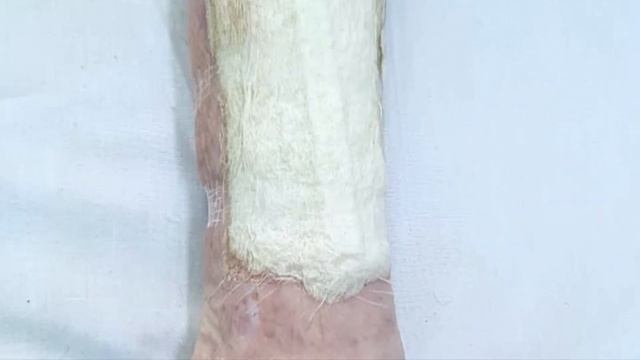 Сохранение нижней конечности смотреть онлайн