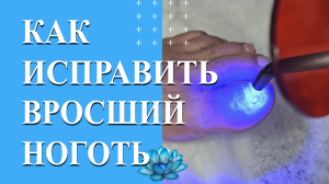 Лечение ногтей на ногах. Реальное удаление вросшего ногтя.