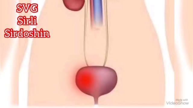 Sistit Kasalligi Va Uni Uy Sharoitida Davolash Usullari