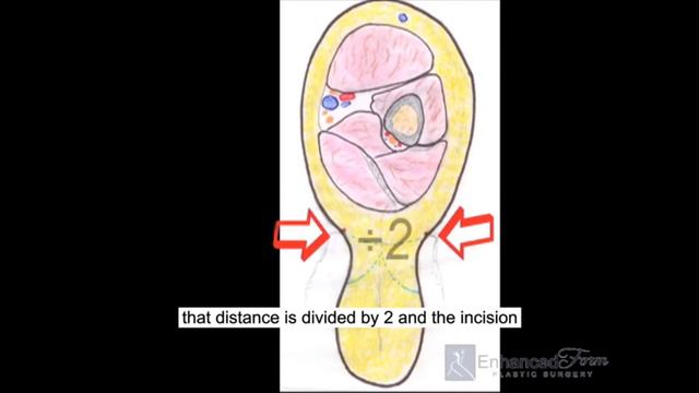 Brachioplasty Chicago with Dr. Makhlouf смотреть онлайн