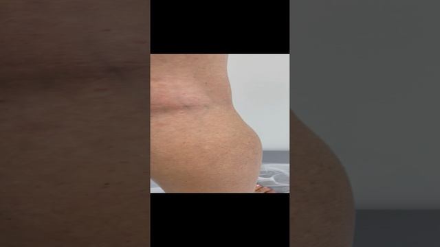 Варикоза нет. Склеротерапия не показана. Флеболог Москва. Флеболог смотреть онлайн