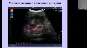 Дуплескное сканирование почечных сосудов Малыхина Е С