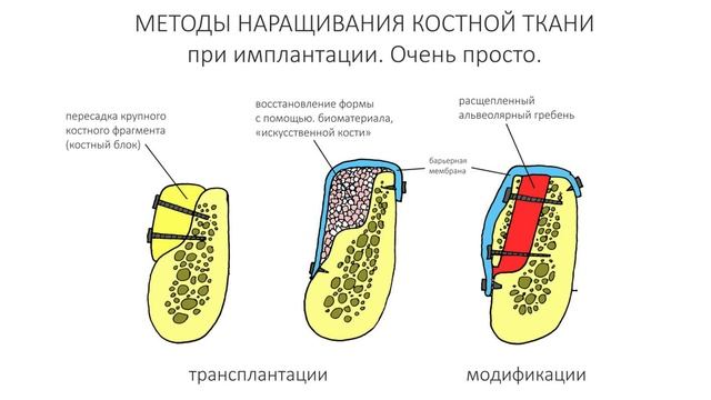 Наращивание костной ткани, пересадка костных блоков для имплантации зубов. смотреть онлайн