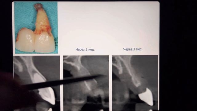 Вывод №5 Зуб с «кистой» надо лечить! Лечение кисты зуба под микроскопом? Зуб имплант. Киста зуба