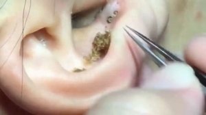 Большая Чёрная ТОЧКА.  Удаление комедона