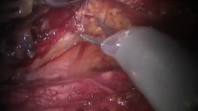 Lymph nodes dissection along recurrent laryngeal nerve for esophageal cancer смотреть онлайн