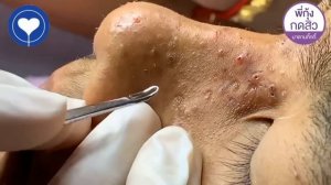 Полная чистка лица. Удаление и выдавливание чёрных точек. Выдавливание прыщей. Часть 2