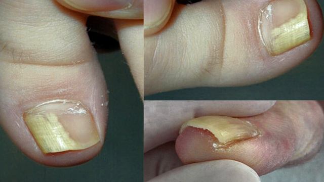 Онихолизис. Онихолизис это. Онихолизис как лечить. смотреть онлайн