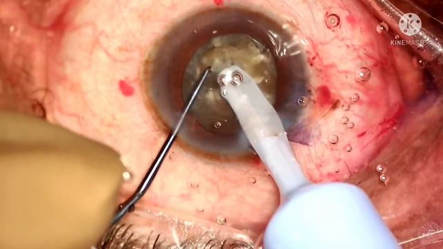 Phacoemulsification of NS 3-4 cataract by vertical chop on Stellaris PC смотреть онлайн