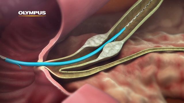 QuickPlaceV Biliary Stent смотреть онлайн