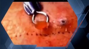УДАЛЕНИЕ ОГРОМНОЙ ЧЕРНОЙ ТОЧКИ/BLACKHEAD Removal.