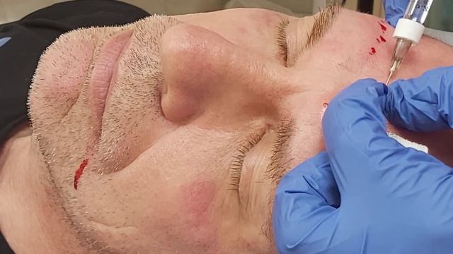 АирисКом студенты учатся: заполнение глубоких морщин филлером. Мужчина в кабинете косметолога. смотреть онлайн