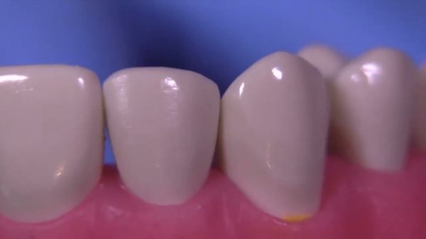 Керамические виниры. Часть 2. Вестибулярные виниры