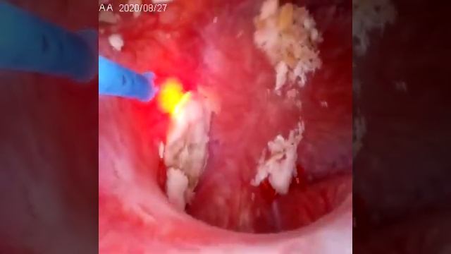 Дробление камней почек в Киеве