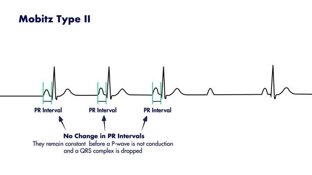 Second Degree Heart Block - Electrocardiogram (ECG/EKG) Interpretation смотреть онлайн