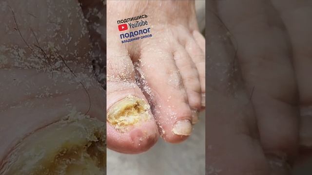 ? Онихогрифоз / Обработка ногтя / Травма ногтя #shorts #подолог #грибокногтей #онихогрифоз смотреть онлайн