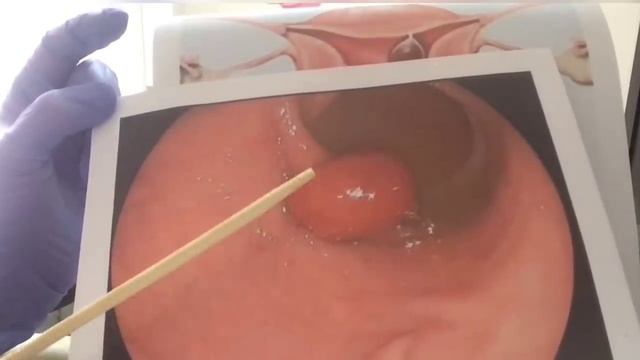 POLIP HAQIDA MA’LUMOTLAR VA UNI DAVOLASH