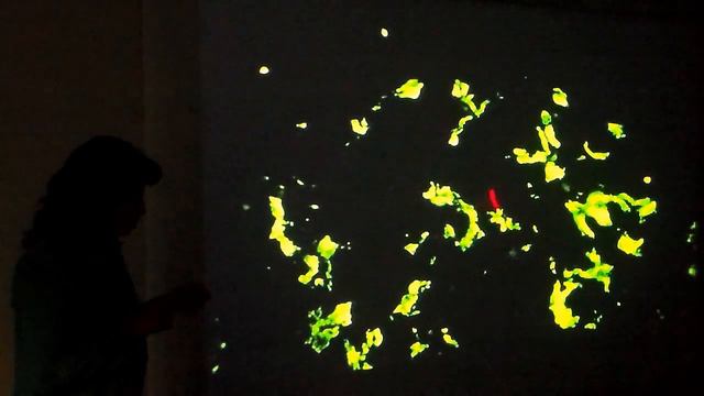IgA nephropathy Prof Eman Sarhan, Ain Shams University1 смотреть онлайн