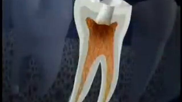 ROOT CANAL PROCEDURE 2 VISITS смотреть онлайн