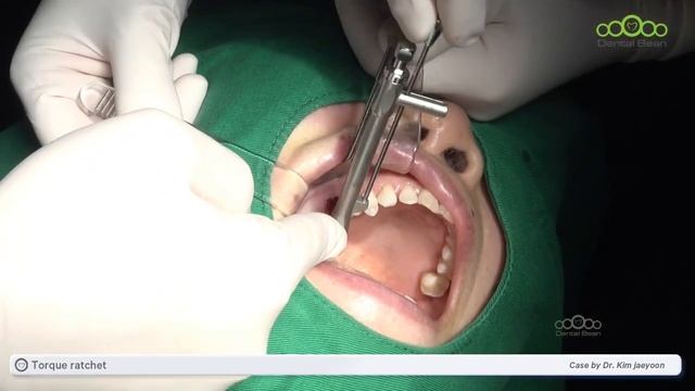 [MULTI_SUB] Immediate implant with core lift with universal kit - [Dr. Kim Jaeyoon] смотреть онлайн