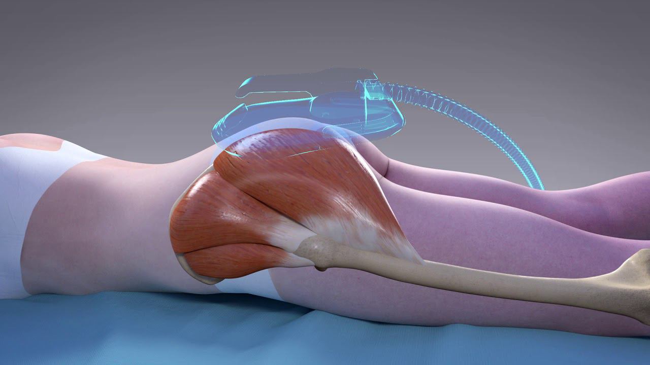 Накачать ягодицы без упражнений легко [Emsculpt] смотреть онлайн