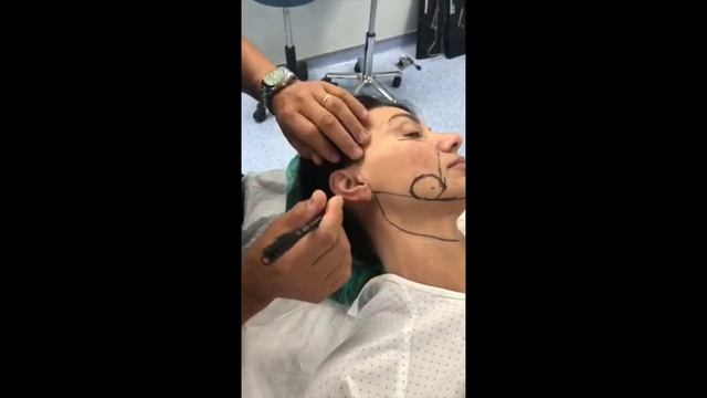 Lifting facial y liposucción de papada - Parte 1 смотреть онлайн