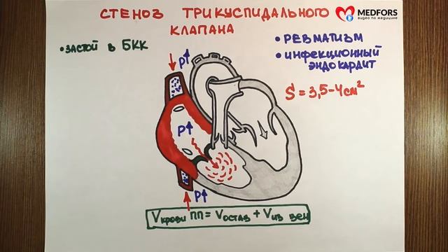 Стеноз трёхстворчатого клапана Просто о сложном смотреть онлайн