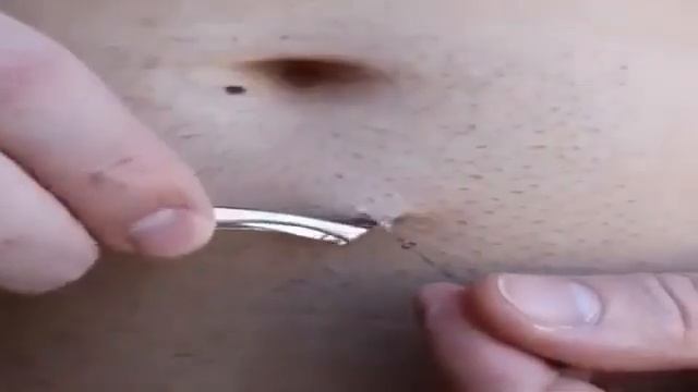 Самый длинный вросший волос смотреть онлайн