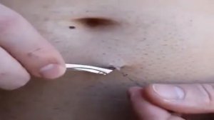 Самый длинный вросший волос