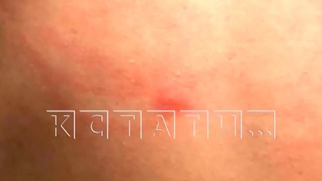 Сотни человек пострадали от червей, которые нападают на купальщиков в озерах смотреть онлайн