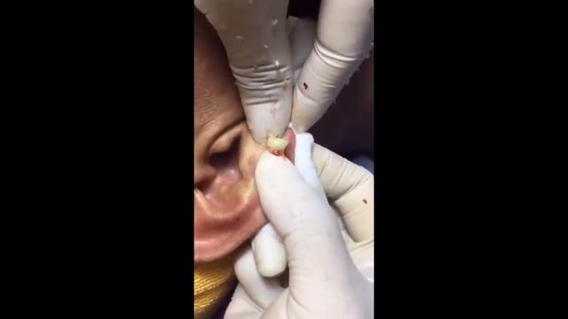 #11 БОЛЬШОЙ ЧИРЕЙ БОЛЬШОЙ ЧИРЯК БОЛЬШОЙ ПРЫЩ БОЛЬШОЙ ГНОЙНИК!!! смотреть онлайн