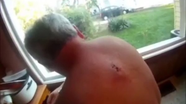 Выдавливание прыщей! 18+