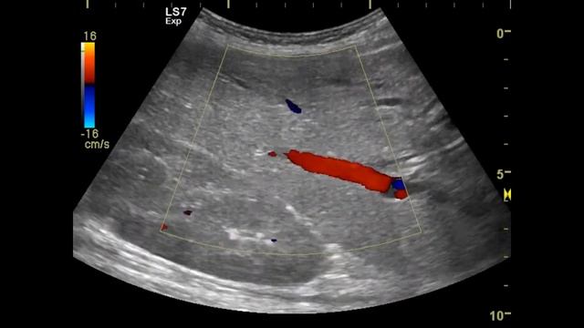 холангиокарцинома смотреть онлайн