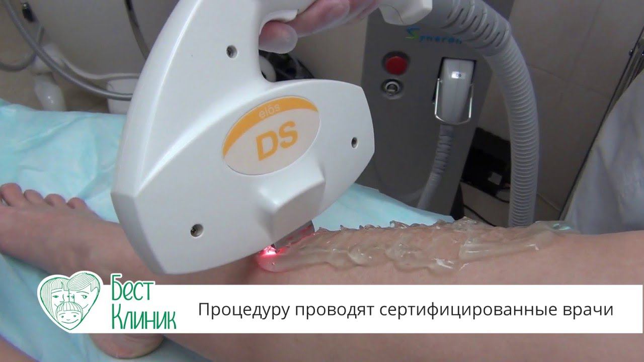 Элос эпиляция в Бест Клиник! смотреть онлайн