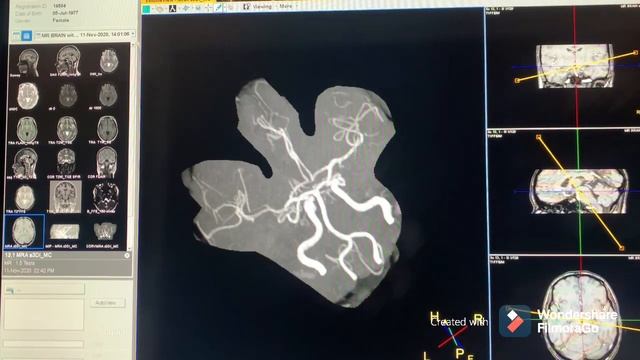 MRI-MRA 3D RECONSTRUCTION CIRCLE OF WILLIS! смотреть онлайн