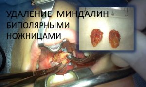 Тонзиллэктомия биполярными ножницами бескровная (ЛОР-хирургическая операция удаления миндалин)