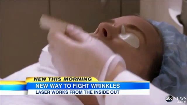 Fotona 3D - Non-Invasive Laser Face Lifting смотреть онлайн