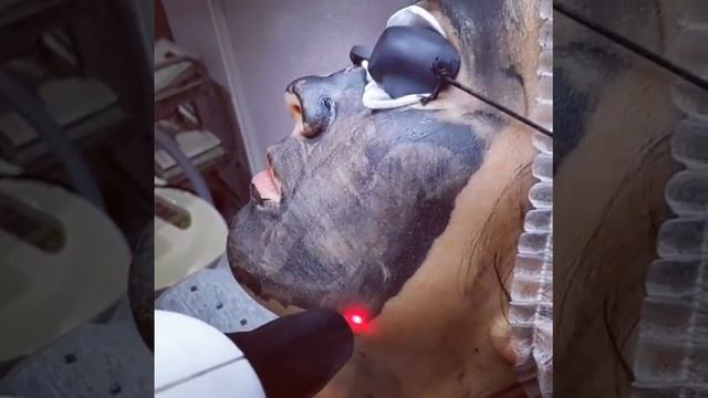 Карбоновый пилинг на аппарате MBT-800