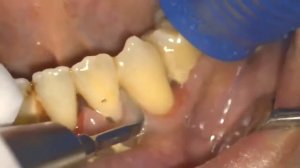 Профессиональная чистка зубов