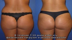 Липофилинг ягодиц: особенности коррекции объема и формы