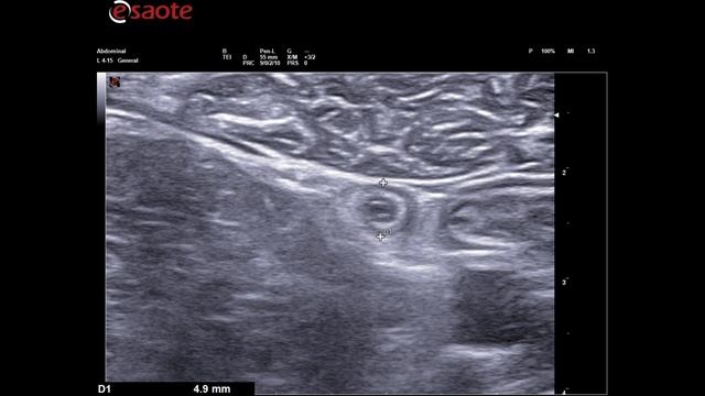 Нормальный аппендикс. Normal appendix смотреть онлайн