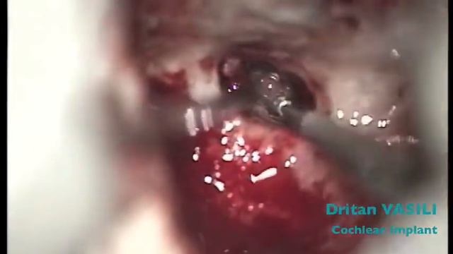 First Cochlear Implant In Albania