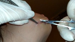 Снять шов с раны в домашних условиях за 1 минуту